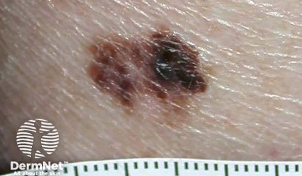 melanoma