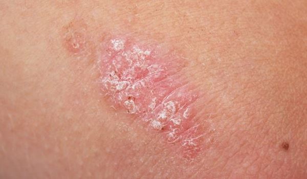 Psoriasis plaque