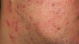 Moderate acne